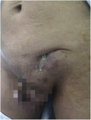 Hernia mesh infection treatment following the repair of abdominal wall hernias: A single-center experience
